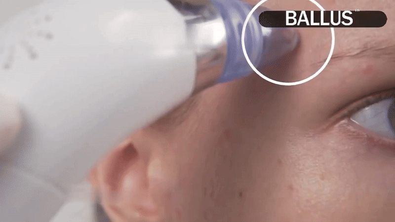 Pore Cleaning Device - buyverso